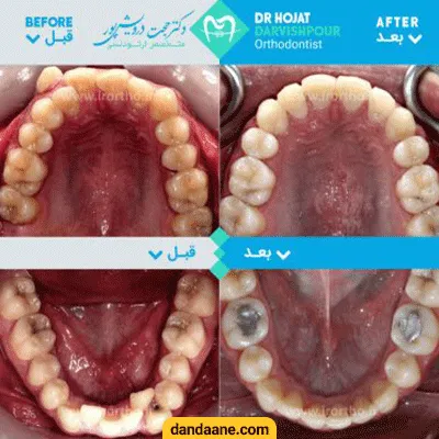 قبل و بعد نمونه کار درمان بی نظمی های دندانی دکتر حجت درویش پور کاخکی