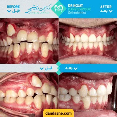 قبل و بعد نمونه کار ارتودنسی دکتر حجت درویش پور کاخکی