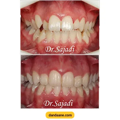 قبل و بعد نمونه کار ارتودنسی دکتر سودابه سجادی