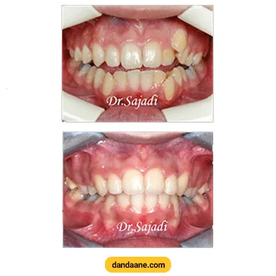 قبل و بعد نمونه کار درمان بی نظمی های شدید دندان دکتر سودابه حسینی