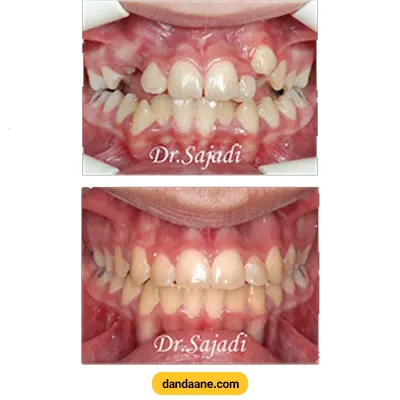 قبل و بعد نمونه کار هدایت نیش نهفته به داخل قوس توسط دکتر سودابه حسینی