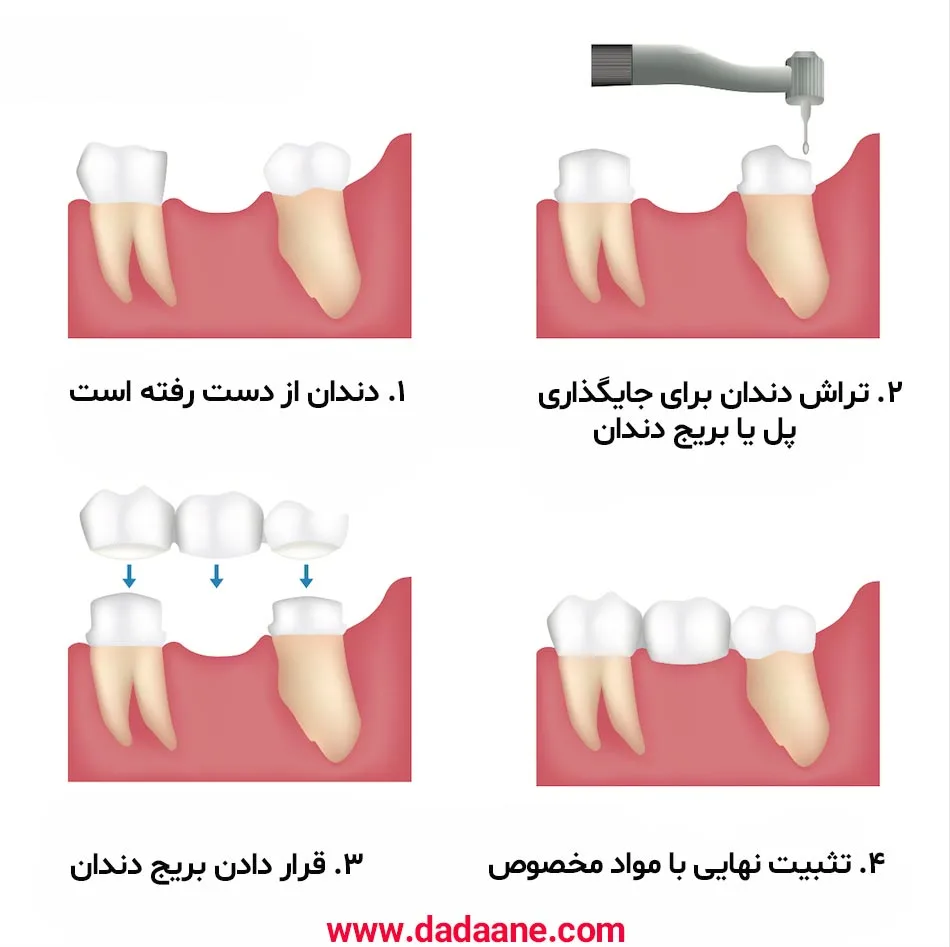 عکس از مراحل بریج دندان 