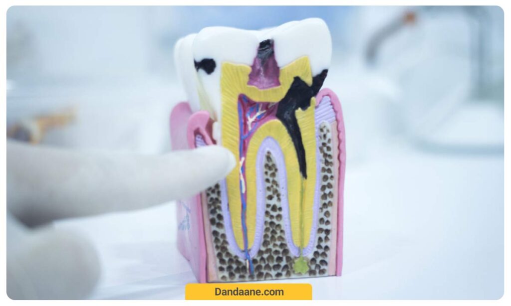 تصویر ماکت مربوط به عصب کشی دندان