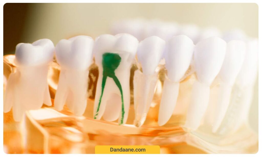 تصویر ریشه دندان که با رنگ سبز مشخص شده