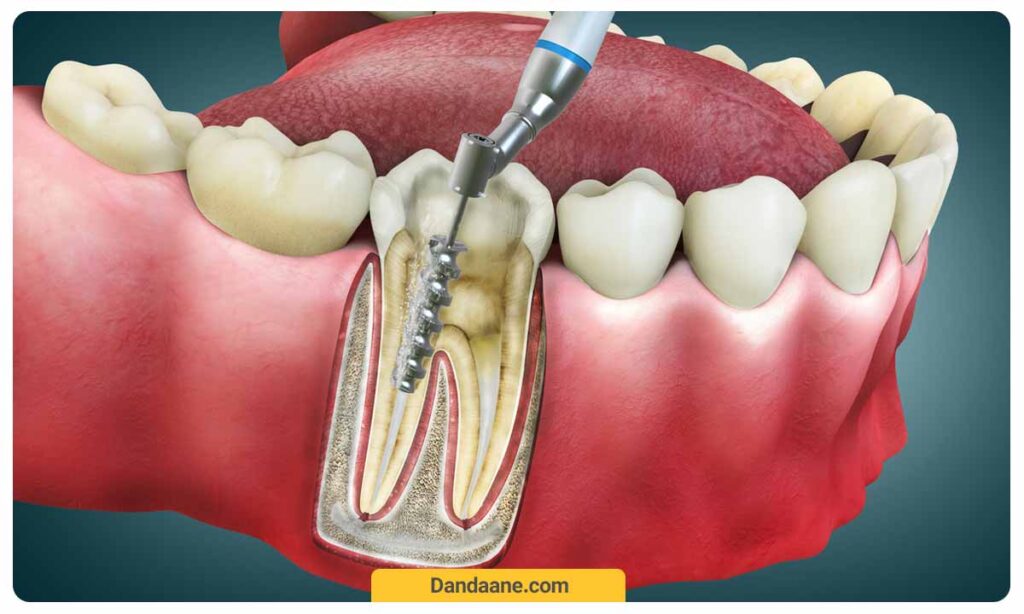 تصویر شماتیک عصب کشی دندان