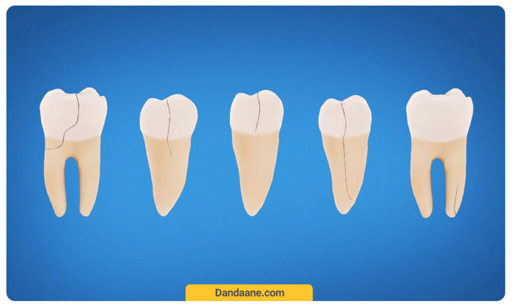 تصویر شماتیک از انواع شکستگی دندان