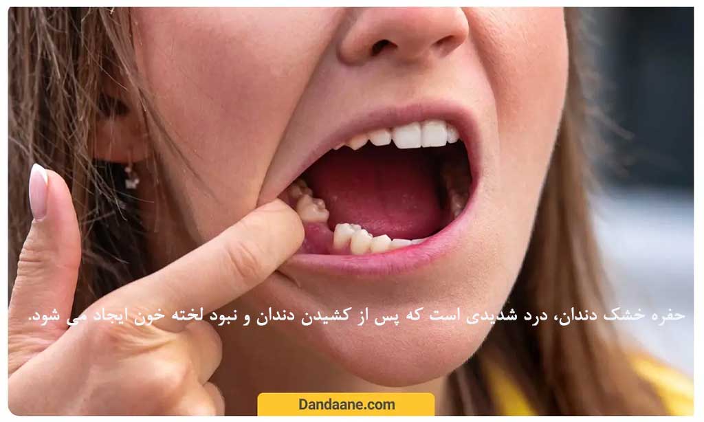 حفره خشک دندان