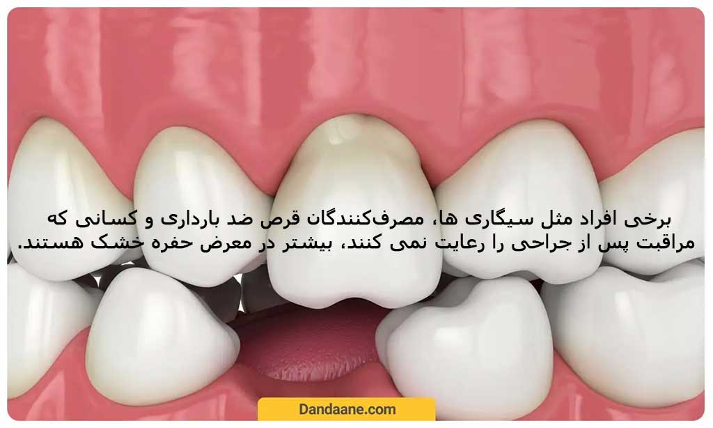 چه کسانی بیشتر در معرض حفره خشک دندان قرار دارند؟