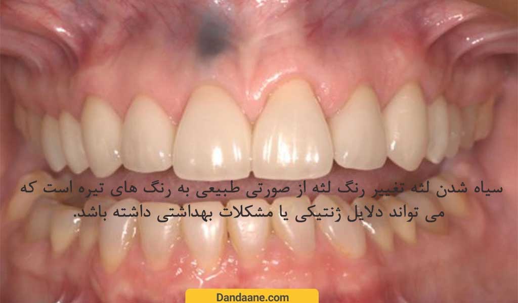 سیاه شدن لثه