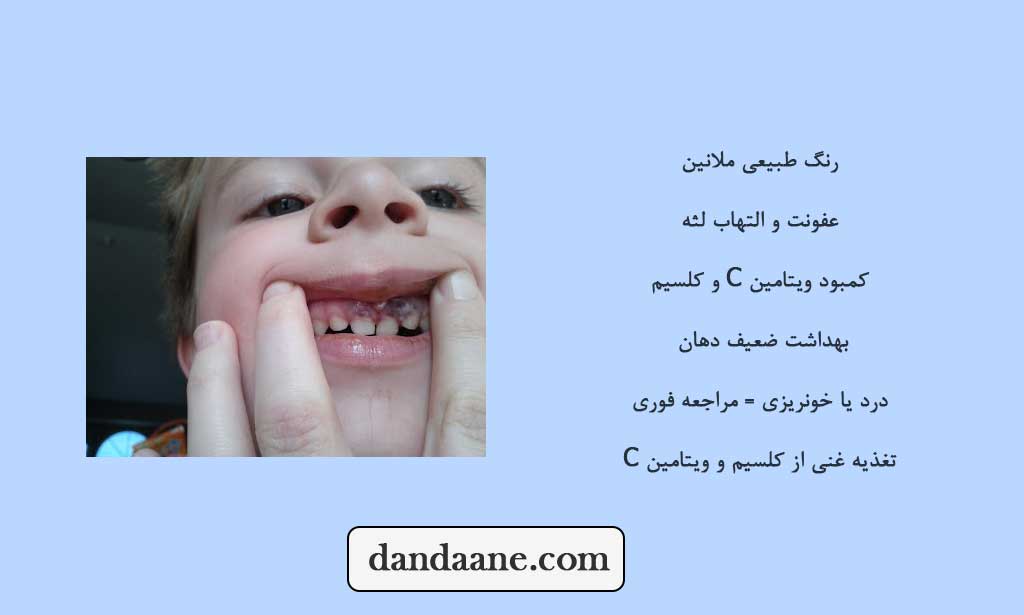 دلایل سیاه شدن لثه در کودکان