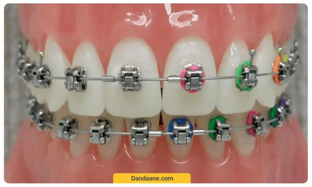 شما می توانید  همزمان از چند رنگ برای ارتودنسی رنگی استفاده نمائید.