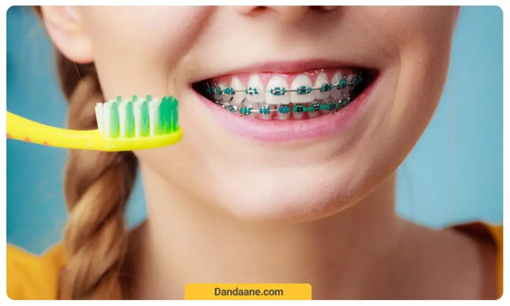 عدم رعایت بهداشت موجب تغییر رنگ دندان و حتی بریس های رنگی می شود 