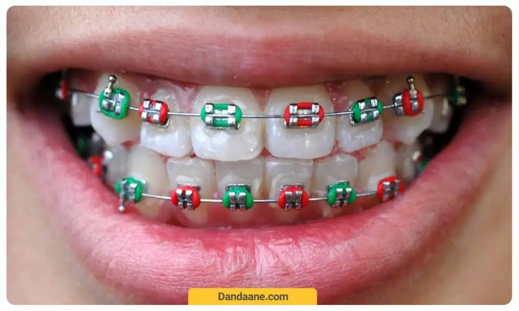 شما می توانید بر اساس رنگ هایی که می پوشید ارتودنسی رنگی را انتخاب نمائید 