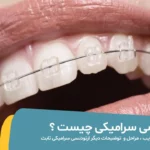 ارتودنسی سرامیکی چیست