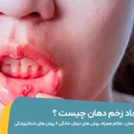 زخم دهان چیست