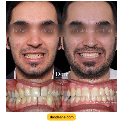 نمونه کار ارتودنسی دکتر امیر کامیار خضری شماره 2