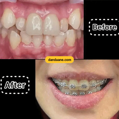 نمونه کار ارتودنسی دکتر مریم پوستی