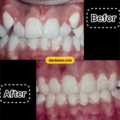 نمونه کار ارتودنسی دکتر مریم پوستی شماره 3