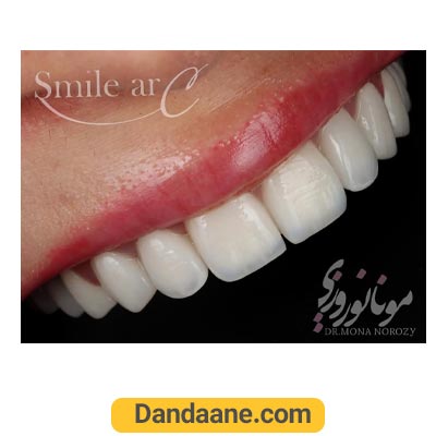 نمونه کار بعد لمینت دندان دکتر مونا نوروزی