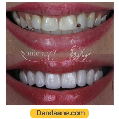 یک نمونه کار بعد و قبل لمینت دکتر مونا نورورزی