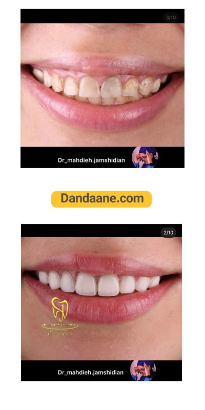 یک نمونه کار قبل و بعد لمینت دندان دکتر مهدیه جمشیدیان