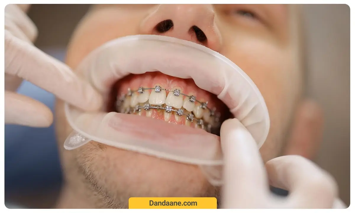 ارتودنسی ثابت 