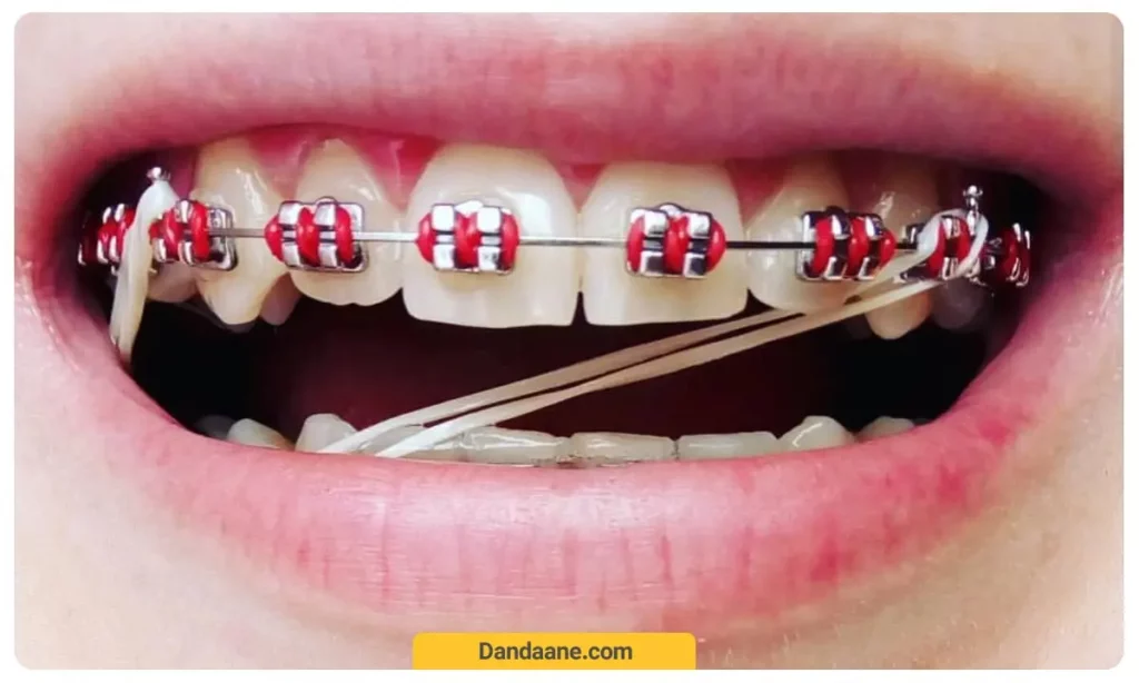 ارتودنسی قرمز 