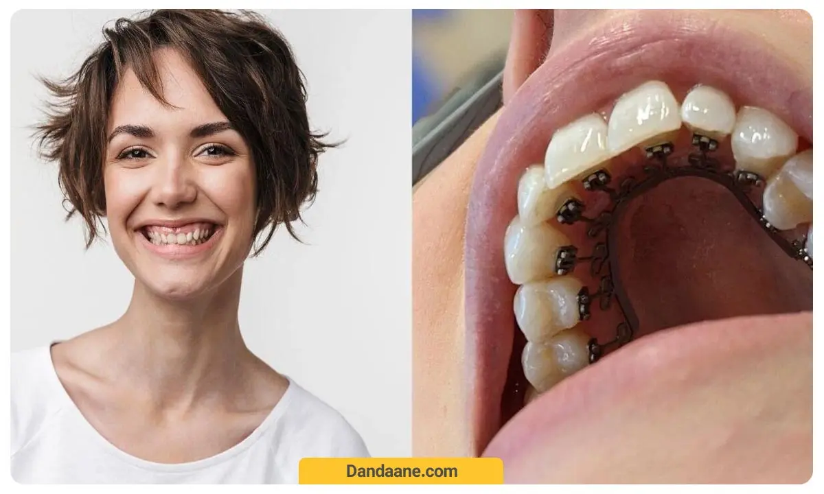 عکس ارتودنسی نامرئی لینگوال| هزینه ارتودنسی نامرئی