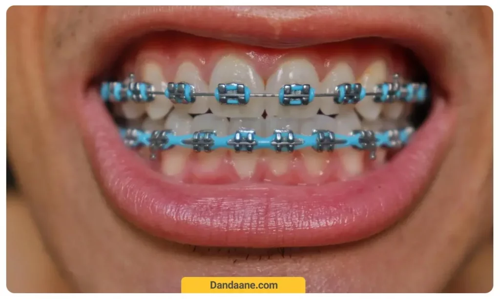 ارتودنسی آبی 