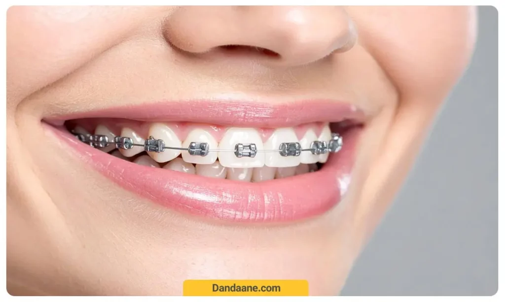 ارتودنسی نقره ای 