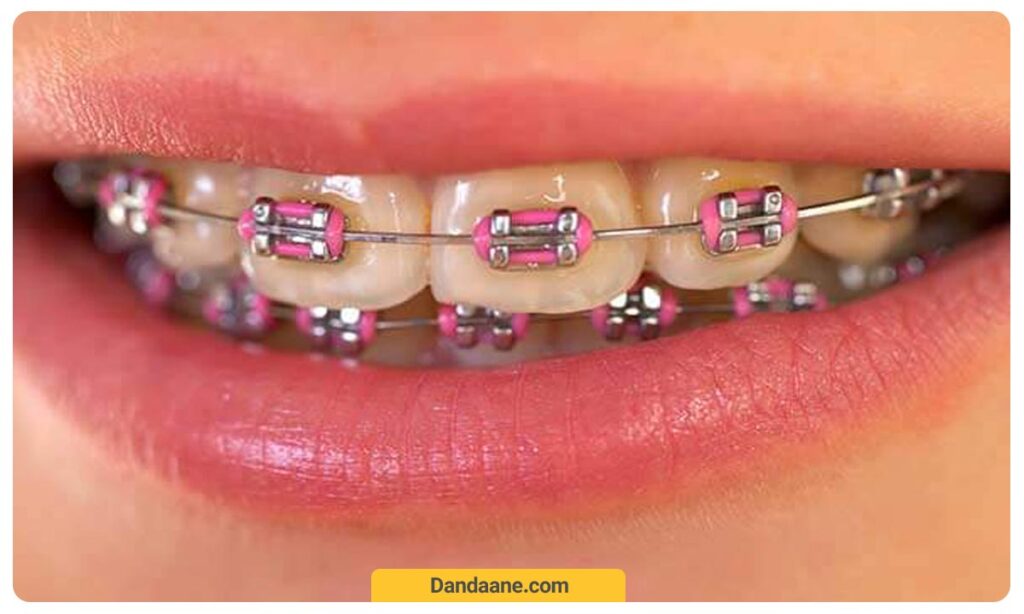 رنگ صورتی ارتودنسی 