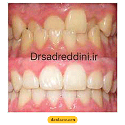 نمونه کار ارتودنسی دکتر فرهاد صدرالدینی شماره 1
