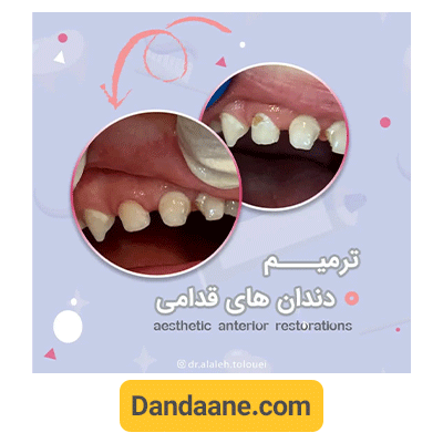 نمونه کار ترمیم دندان های قدامی توسط دکتر آلاله طلوعی 