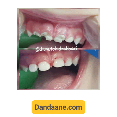 نمونه کار ترمیم دندان های قدامی توسط دکتر منیره توحید رهبری