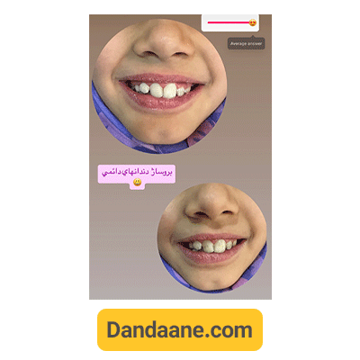 نمونه کار دکتر کوثر سادات ابطحی برای بروساژ دندان کودکان - شماره 3