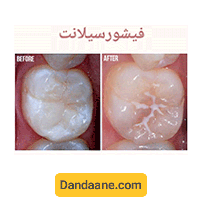 نمونه کار قب لو بعد فیشرو سیلانت