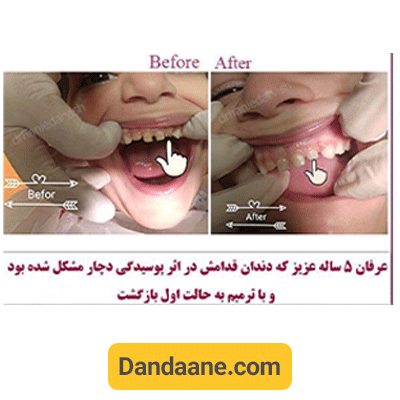 نمونه کار قبل و بعد نمونه کار دکتر هانیه درویش دماوندی