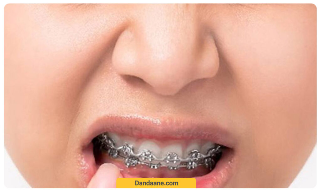 لق شدن دندان در طول ارتودنسی