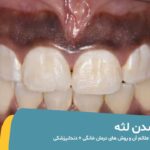 سیاه شدن لثه