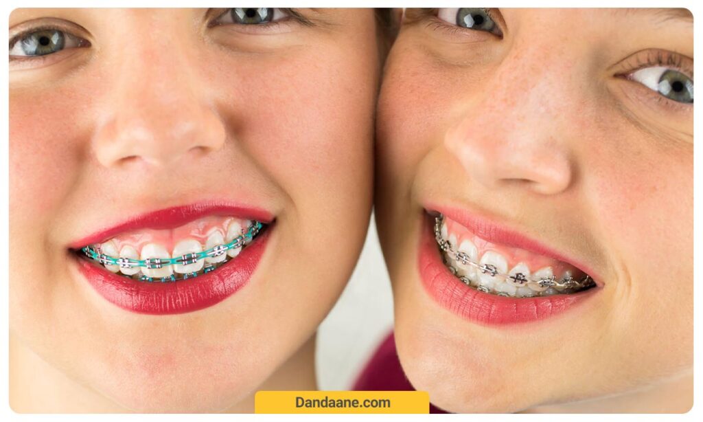 ارتودنسی کودکان با بریس های سرامیکی