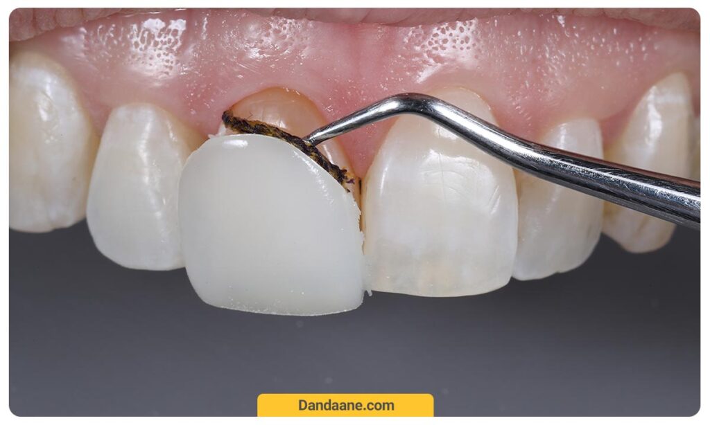 ریمو لمینت دندان