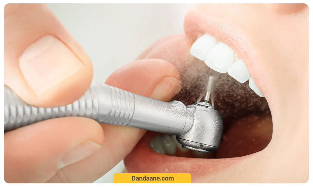 تراشیدن دندان برای کامپوزیت و لمینت