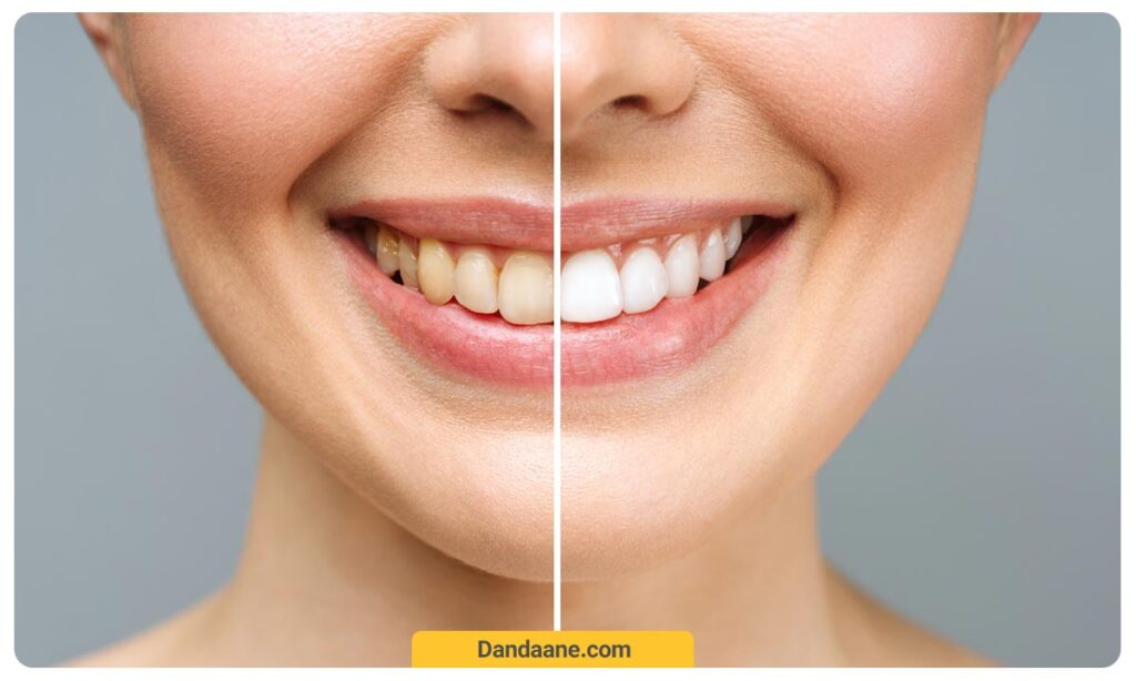 تصویری از تغییر رنگ کامپوزیت دندان