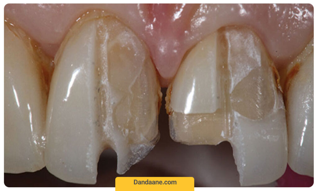 شکستن لمینت دندان