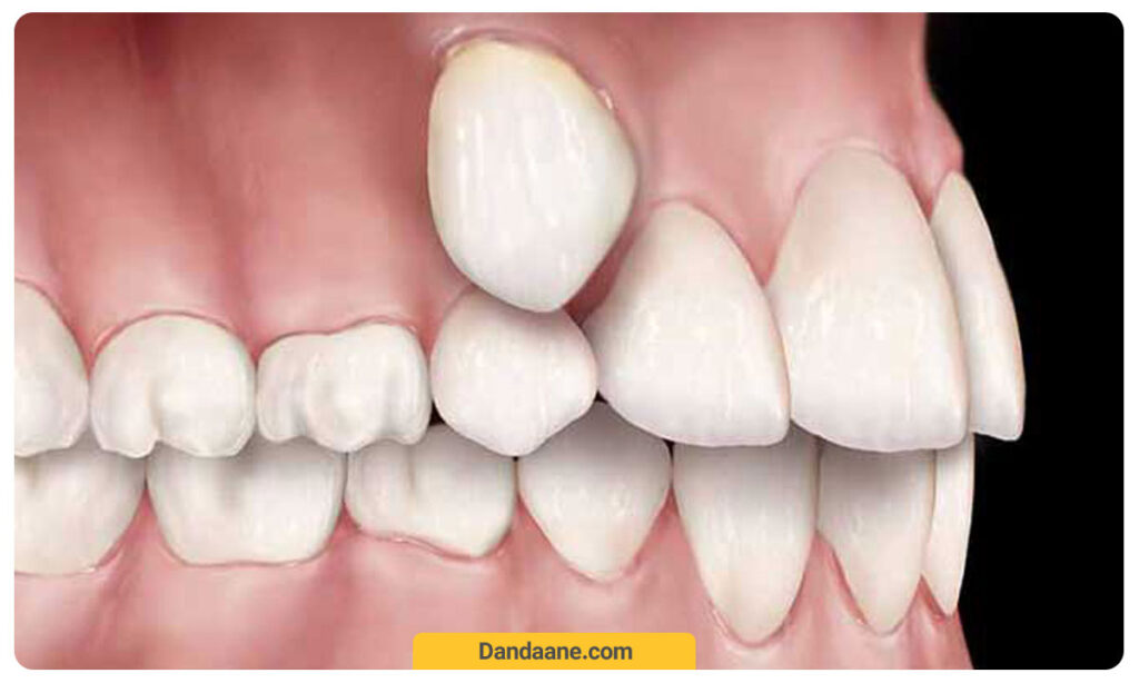 رشد دندان بالای لثه