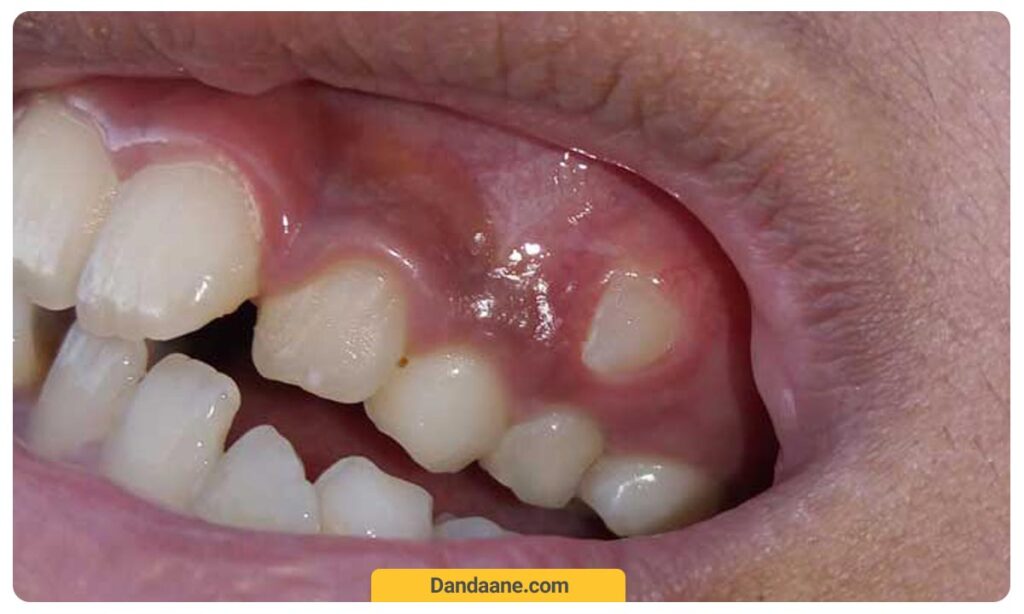 عکس درآمدن دندان بالای لثه