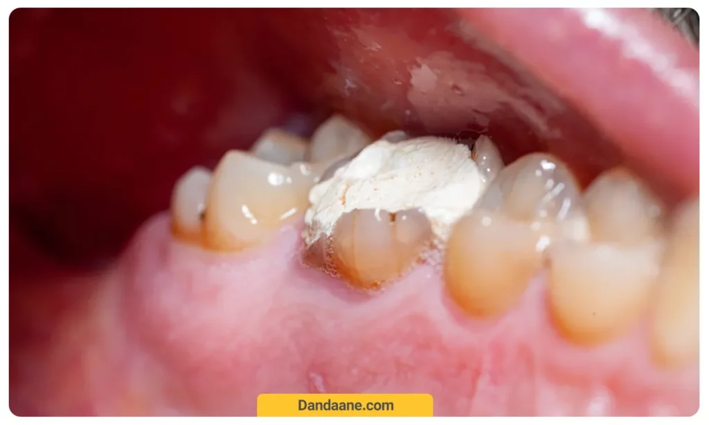 عکسی از نصب روکش دندان عصب کشی شده